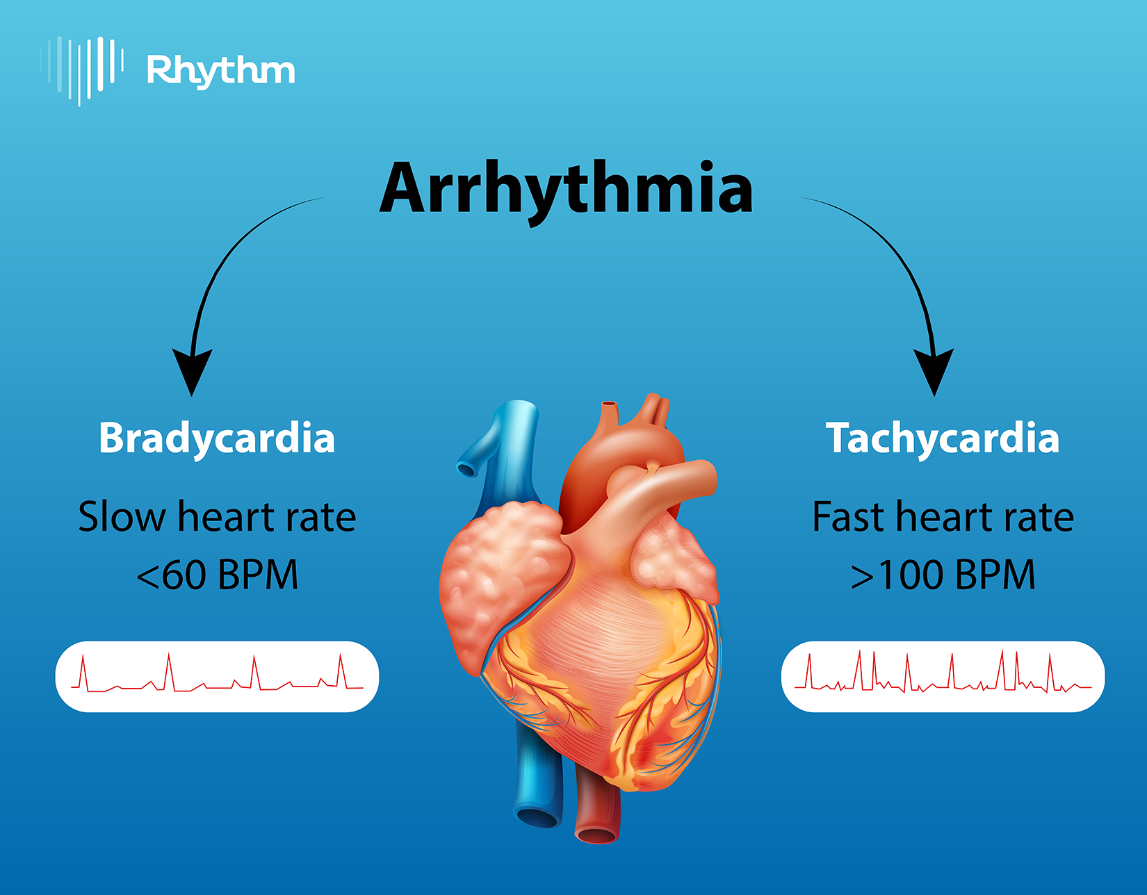 Arrhythmias The Heart Rhythm Problems You Need to Know About MyRhythmNow